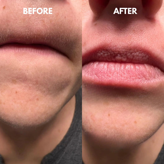 SilkTwist™ | Gladde Huid Zonder Mesjes of Chemicaliën |